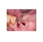 Broca de Osso ALLPORT H141AX-RAL-035 (3 uni.) - Image 2